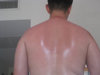 Einschlafen am Strand ... üblen Sonnenbrand gab's inklusive